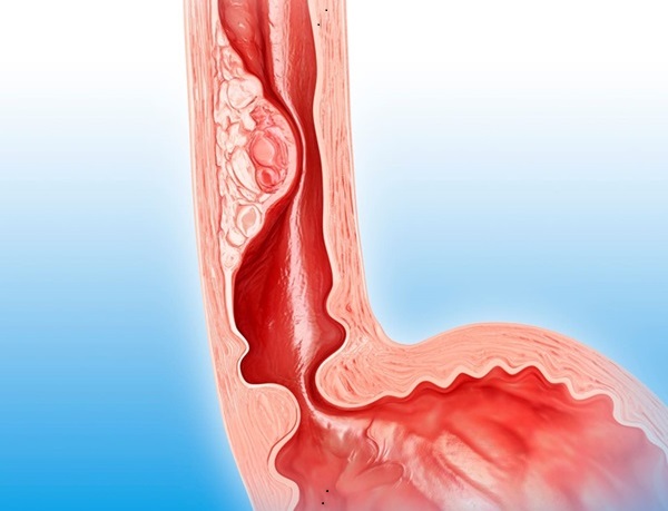 Imagen: Un sistema de aprendizaje profundo puede ayudar en la detección temprana de cánceres de esófago durante una endoscopia de rutina